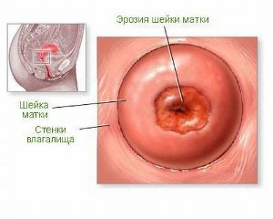 Комплексная терапия ВПЧ 16 типа, 18, 31 и 33 типа Комплексная терапия ВПЧ 16 типа, 18, 31 и 33 типа